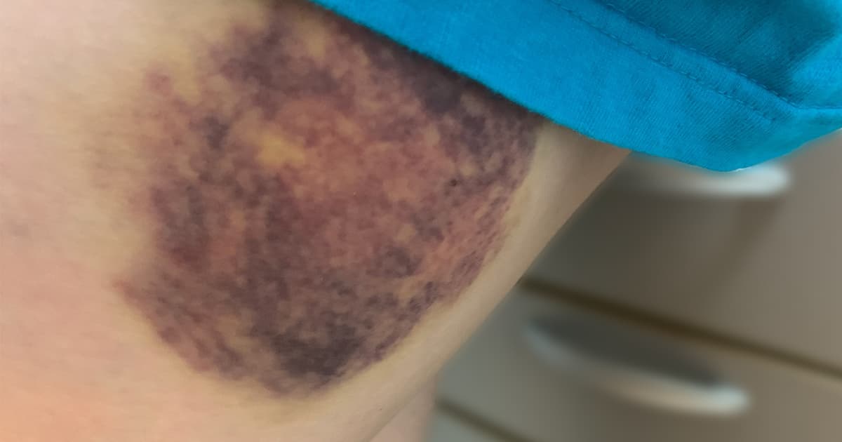 普通二輪免許で転倒、青あざができました